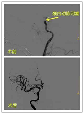 神经内科脑血管病介入