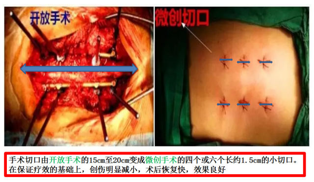 PPS微创治疗脊柱骨折
