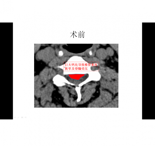 常规颈椎后路手术治疗颈椎管狭窄症+颈椎后纵韧带骨化症