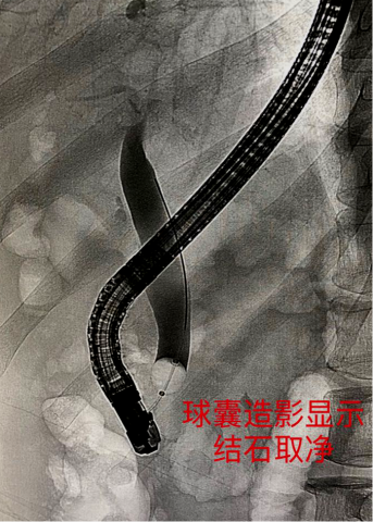 内镜下逆行胰胆管造影