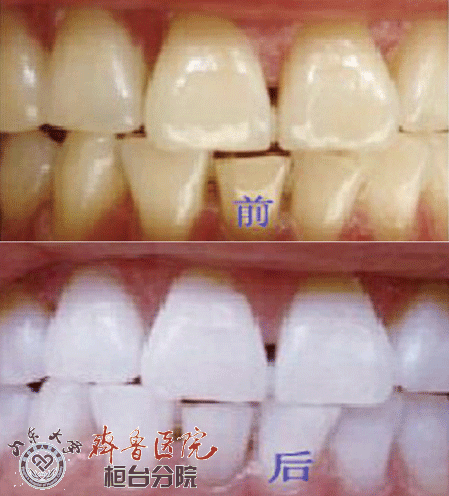 牙齿美白对比.gif
