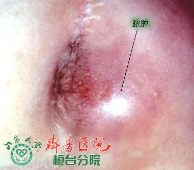 肛周脓肿2.jpg