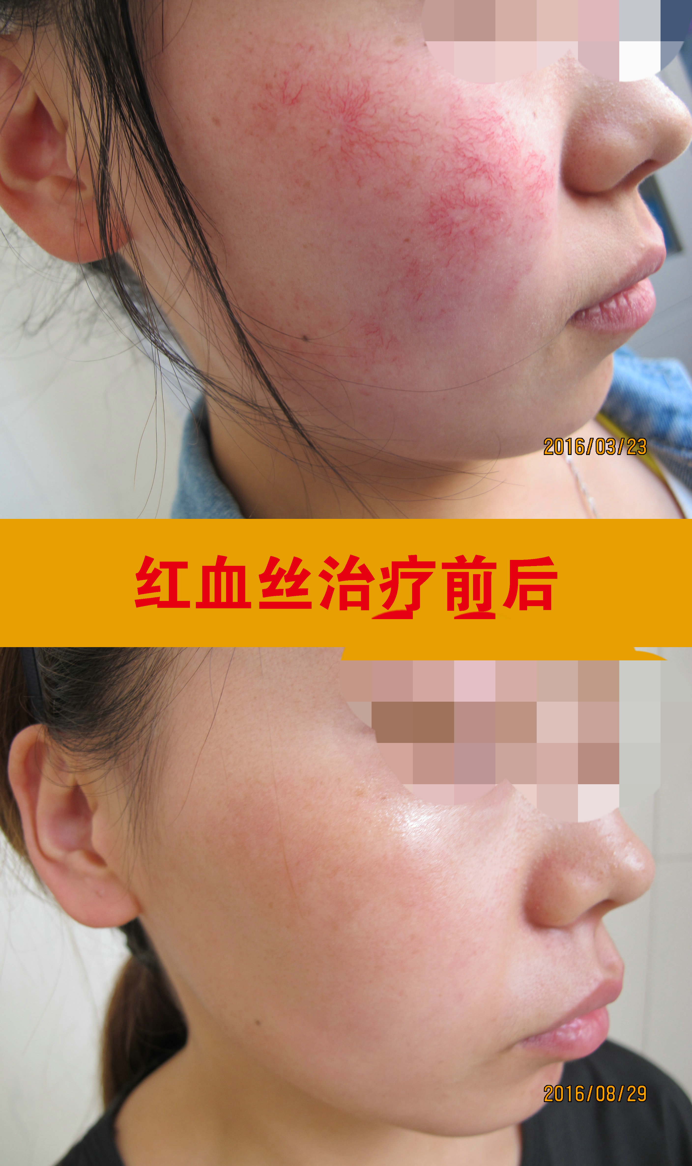 红血丝治疗前后_副本.jpg 红血丝治疗前后_副本.jpg