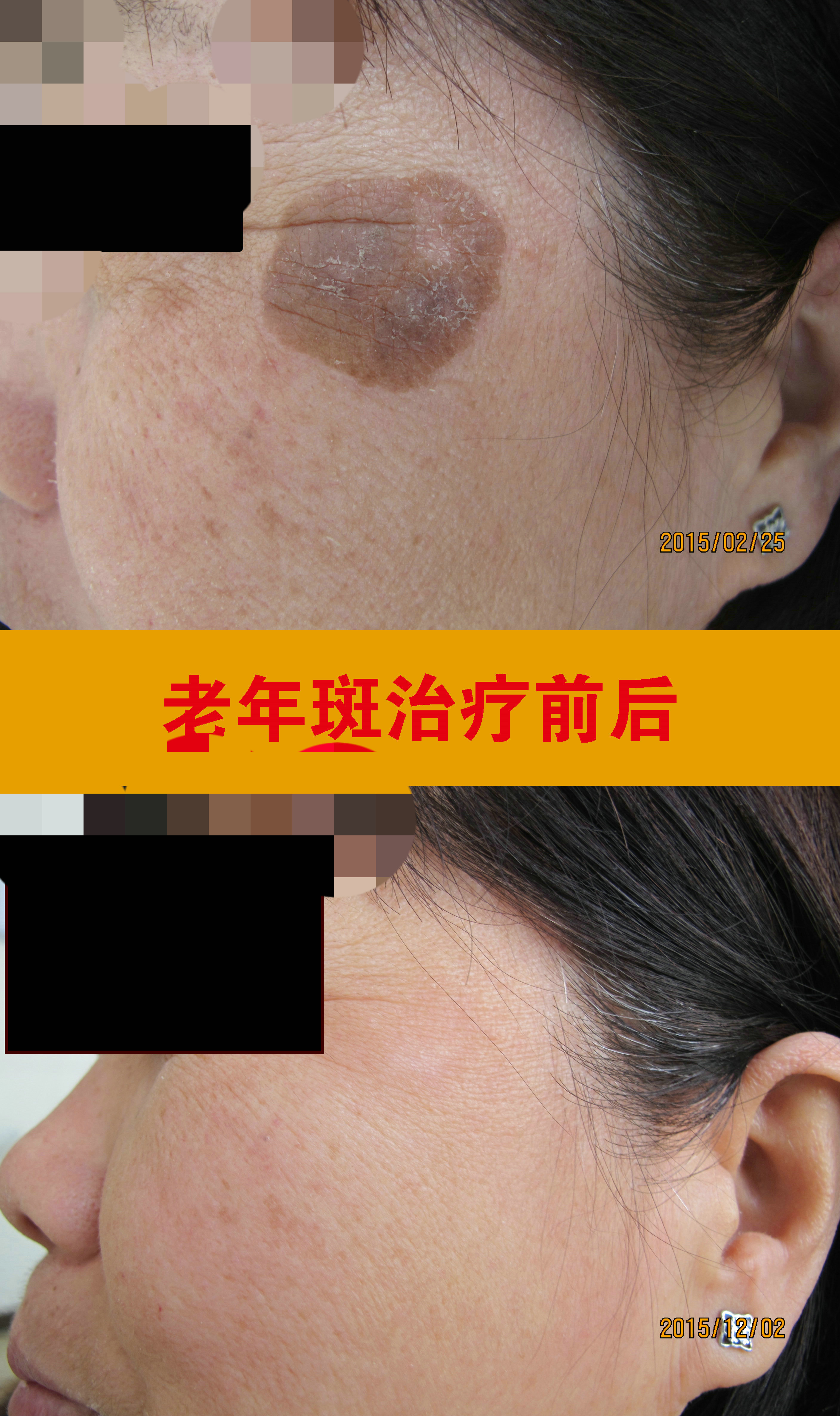 老年斑治疗前后2 (2).jpg 老年斑治疗前后2 (2).jpg