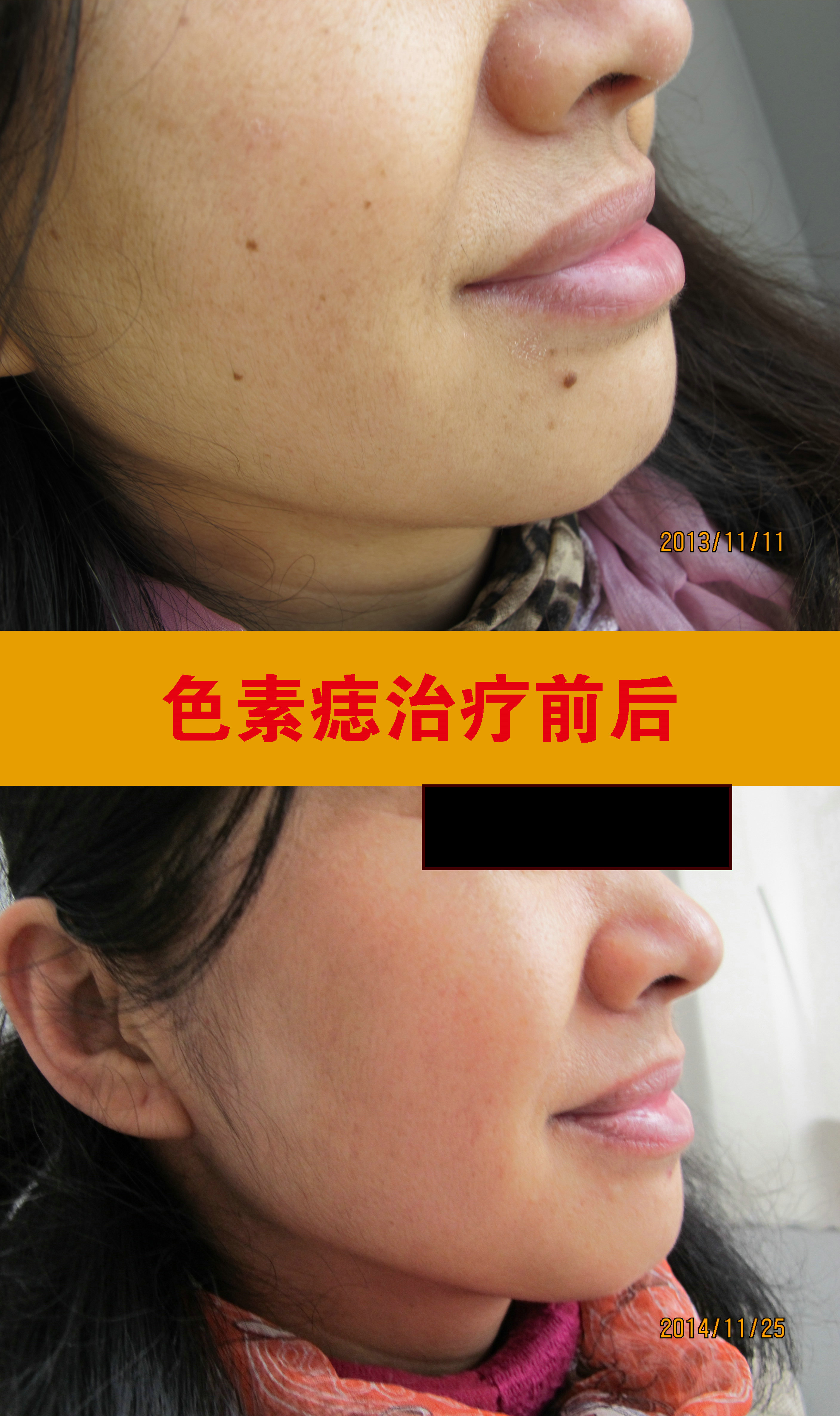 色素痣治疗前后_副本.jpg 色素痣治疗前后_副本.jpg